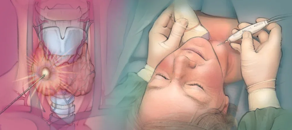 Diagram of ultrasound-guided radiofrequency ablation of a thyroid nodule